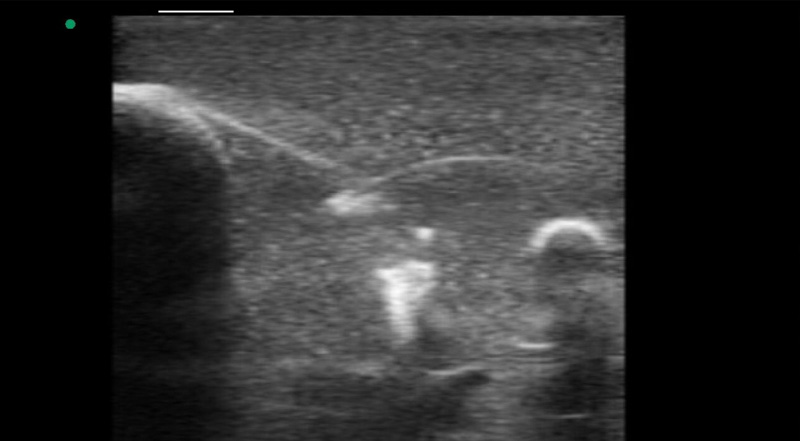 Wireless Ultrasound for Treinamento de biópsia mamária