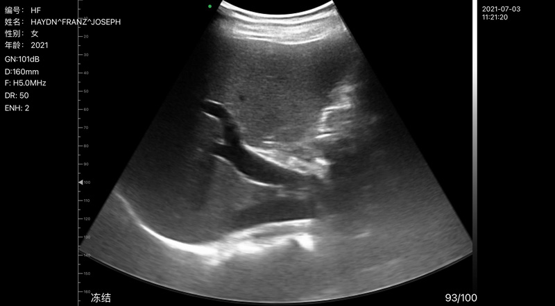 Wireless Ultrasound for Fígado B