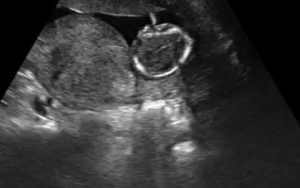 Sonda abdominal Fetal B