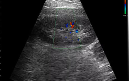 Sonda abdominal Ultra-som rim C