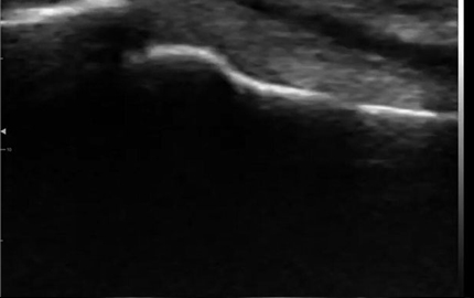 Tendão de Flexor de Dedo de Sonda de Ultrassom Linear Curvo